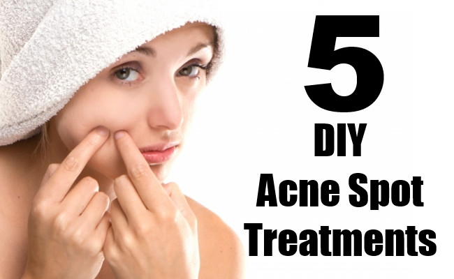 Best ideas about DIY Spot Treatment
. Save or Pin 5 Amazing DIY Acne Spot Treatments For Getting Rid The Now.