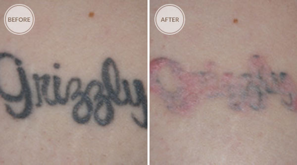 Best ideas about DIY Tatoo Removal
. Save or Pin Natural Tattoo Removal Effective Ways How To Remove Now.