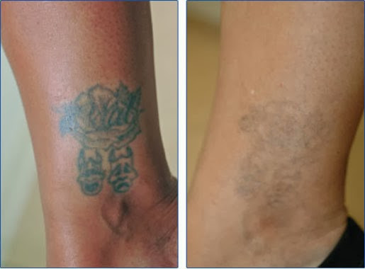Best ideas about DIY Tatoo Removal
. Save or Pin Natural Tattoo Removal How To Remove Tattoos At Home Now.
