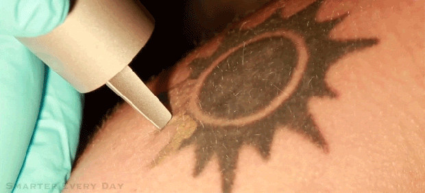 Best ideas about DIY Tatoo Removal
. Save or Pin DIY tattoo removal kit not a good idea after pictures of Now.