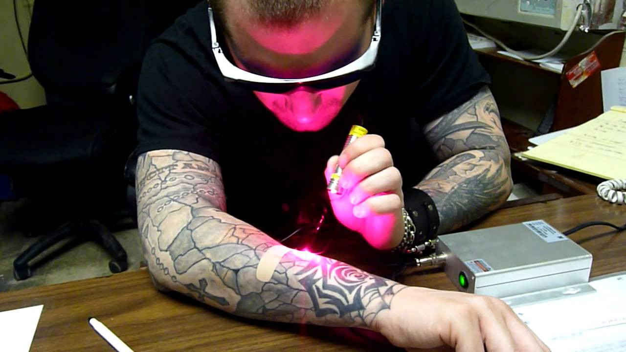 Best ideas about DIY Tatoo Removal
. Save or Pin DIY Laser tattoo removal Don t try this at home Gone Now.