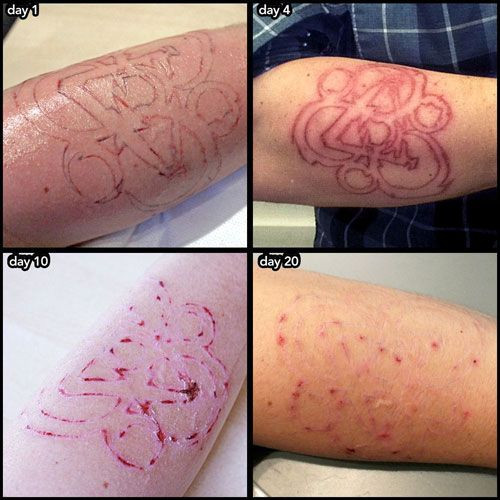 Best ideas about DIY Tattoo Removal
. Save or Pin Tattoo Removal Cream Proces Wrecking Balm Tattoo Removal Now.