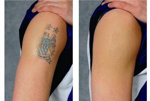 Best ideas about DIY Tattoo Removal
. Save or Pin How To Remove A Permanent Tattoo DIY Methods and Surgical Now.