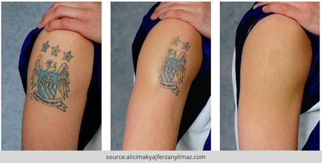 Best ideas about DIY Tattoo Removal
. Save or Pin How To Remove A Permanent Tattoo DIY Methods and Surgical Now.