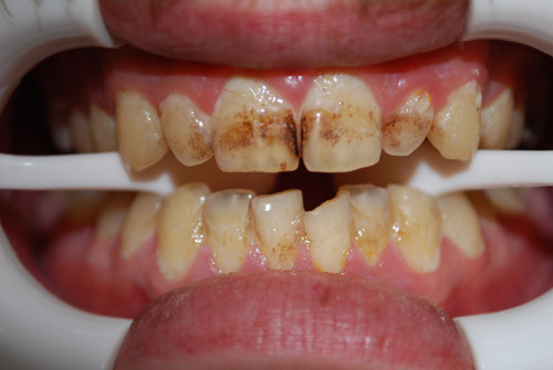 Best ideas about DIY Tooth Paint
. Save or Pin Diy Discolored Tooth Paint Veneer Decal Now.