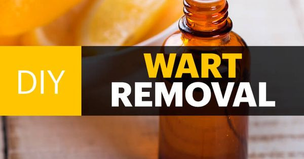 Best ideas about DIY Wart Removal
. Save or Pin DIY Wart Remover with Essential Oils Recipe Now.