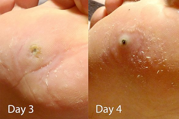 Best ideas about DIY Wart Removal
. Save or Pin DIY Home remedy for Wart Removal Now.