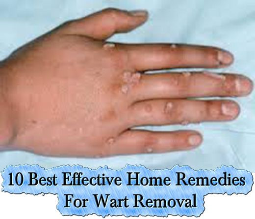 Best ideas about DIY Wart Removal
. Save or Pin 1000 ideas about Best Wart Remover on Pinterest Now.