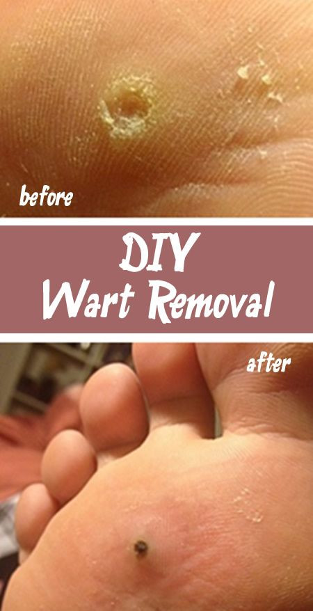 Best ideas about DIY Wart Removal
. Save or Pin DIY Wart Removal Now.