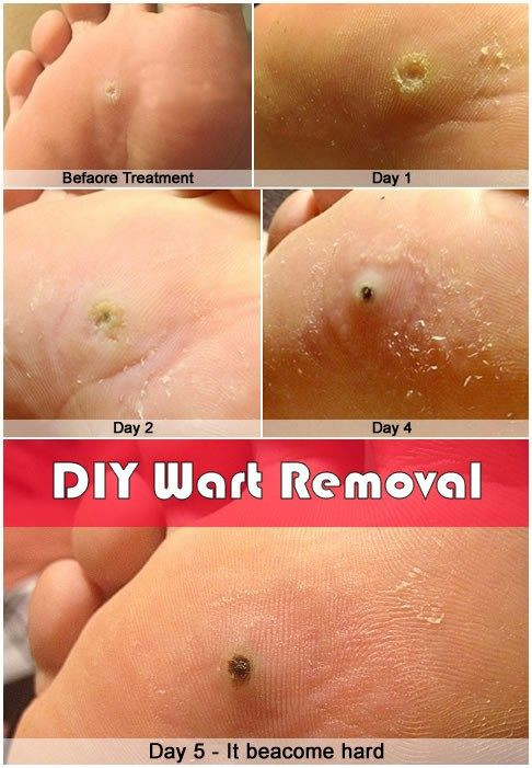 Best ideas about DIY Wart Removal
. Save or Pin 867 Best images about Interresting on Pinterest Now.
