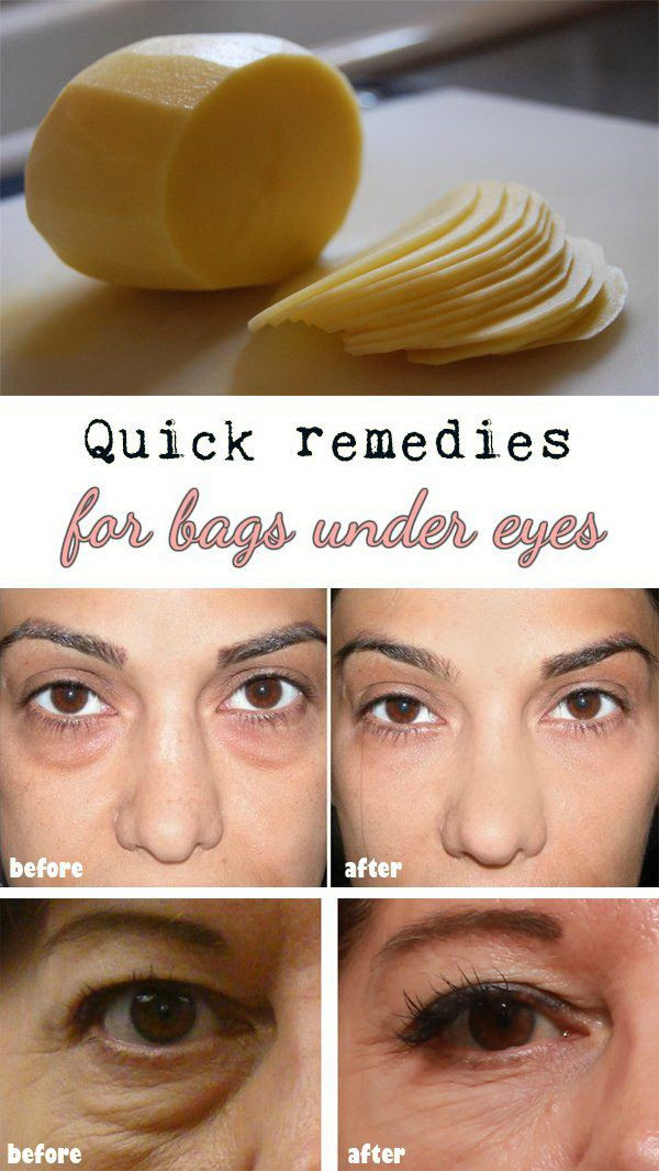 Best ideas about How To Get Rid Of Bags Under Eyes DIY
. Save or Pin 15 Ways to Get Rid of Dark Circles Under Your Eyes Now.