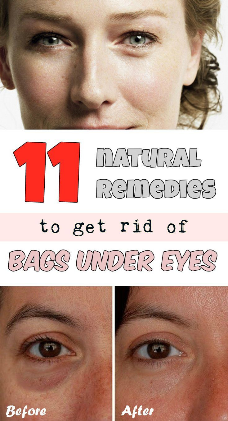 Best ideas about How To Get Rid Of Bags Under Eyes DIY
. Save or Pin 11 natural reme s to rid of bags under eyes Now.
