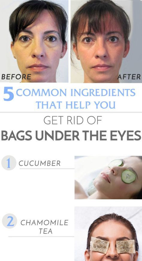 Best ideas about How To Get Rid Of Bags Under Eyes DIY
. Save or Pin How to rid of under the eye bags at home Now.