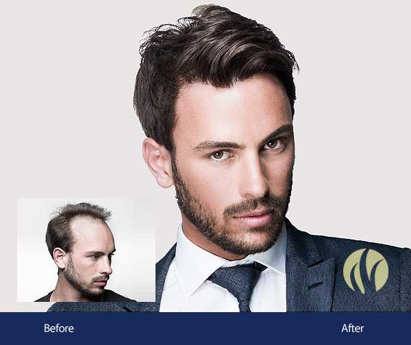 Best ideas about Mens Haircuts Minneapolis
. Save or Pin Men s Hair Replacement Minneapolis Now.