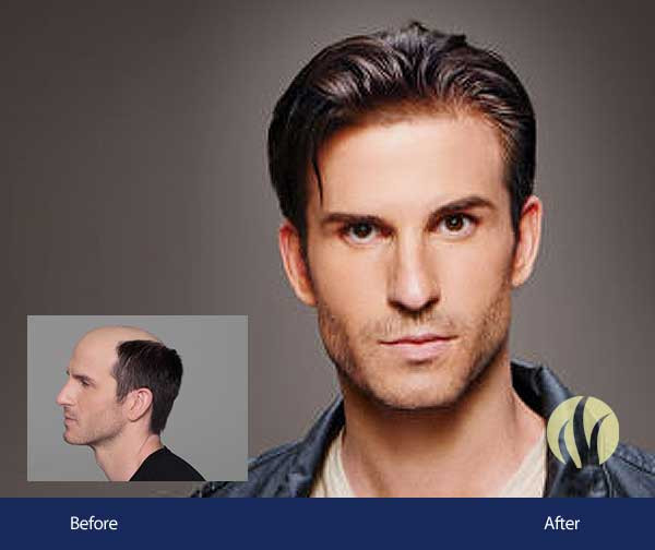 Best ideas about Mens Haircuts Minneapolis
. Save or Pin Men s Hair Replacement Minneapolis Now.