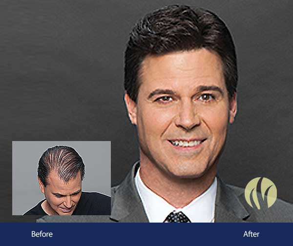 Best ideas about Mens Haircuts Minneapolis
. Save or Pin Men s Hair Replacement Minneapolis Now.