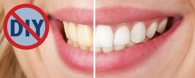 Best ideas about Teeth Whitening DIY
. Save or Pin Teeth Whitening DIY Is it a good or bad idea Now.