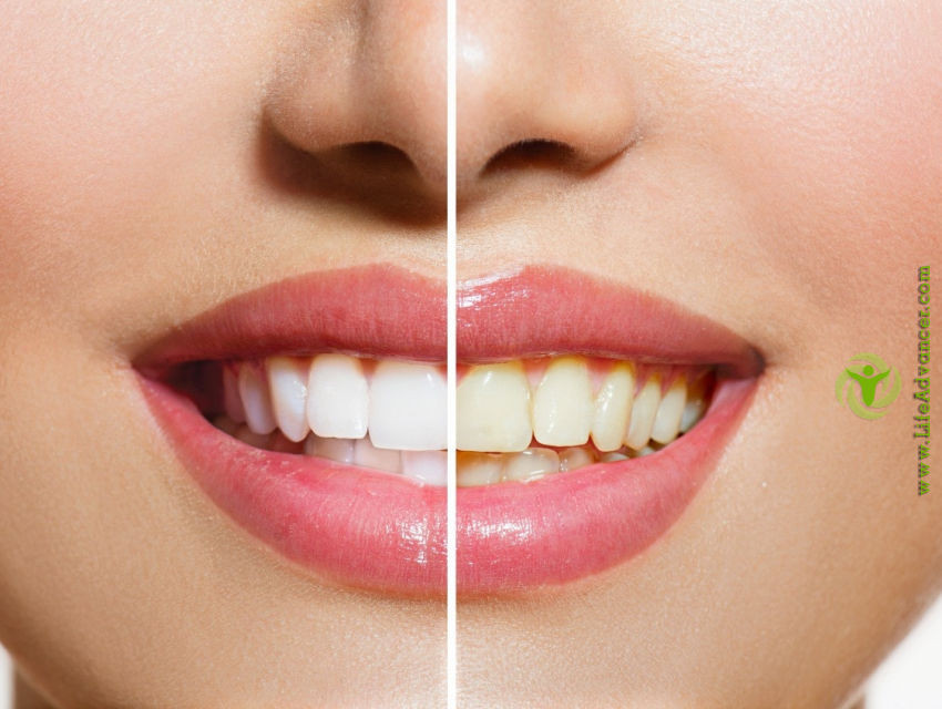 Best ideas about Teeth Whitening DIY
. Save or Pin Best DIY Teeth Whitening Techniques That Will Give You a Now.